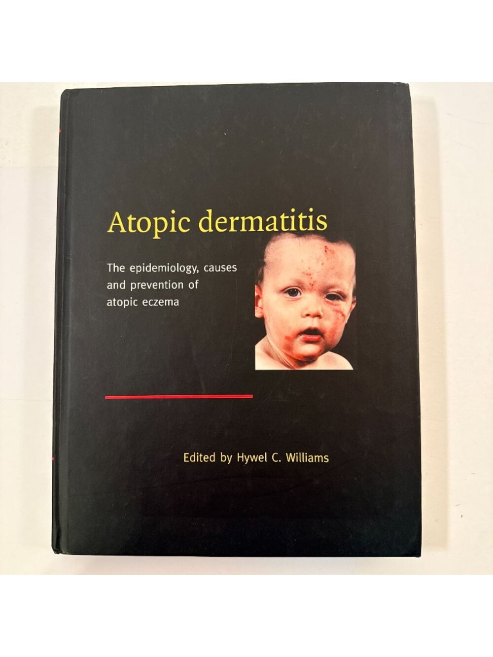 Atopic Dermatitis: The Epidemiology, Causes and Prevention of Atopic Eczema, Hyw
